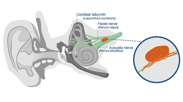 Acoustic neuroma