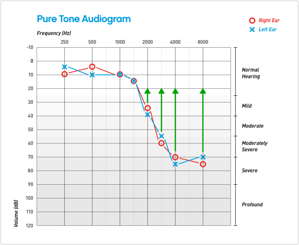 Pure Tone Audiogram with Arrows Illustration