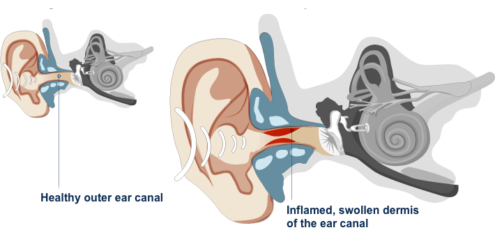 Otitis externa representationt