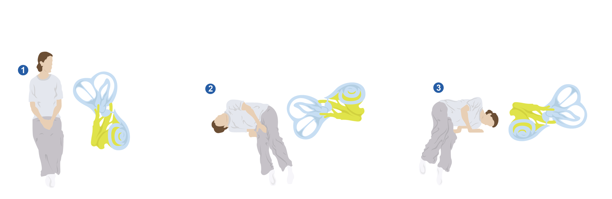 Sémont Maneuver - Step by Step Guide